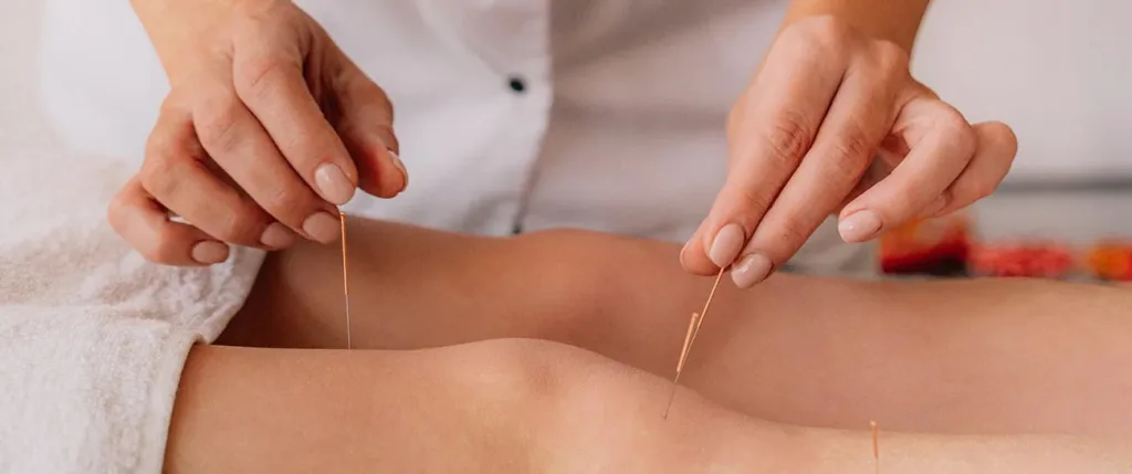 Acupuncture for Stress Relief: Essential Guide to Anxiety Management