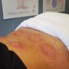 Sports Recovery Acupuncture: Discover 6 Essential Benefits