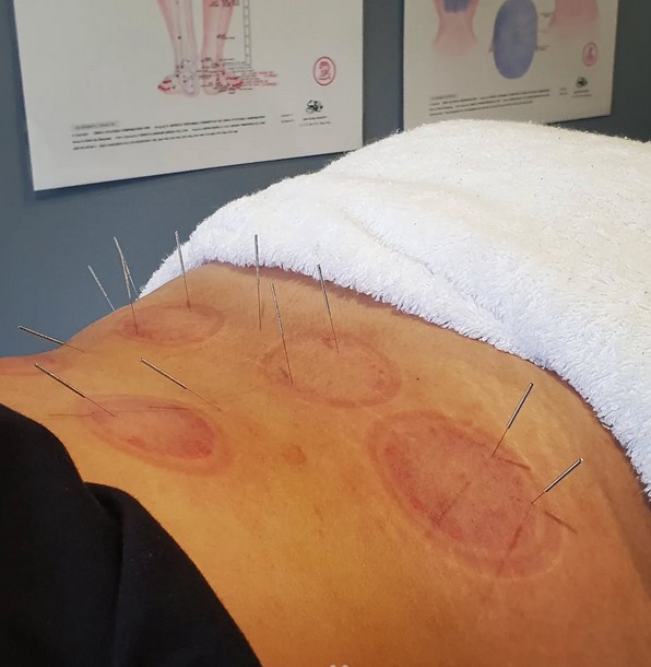Sports Recovery Acupuncture: Discover 6 Essential Benefits