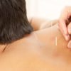 Optimal Sports Recovery with Acupuncture and Cupping Techniques